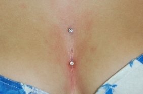 מיקרו דרמאל וספרפס פירסינג